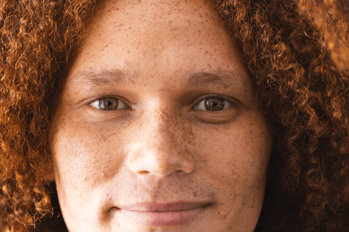 Arbutin cílí na nadprodukci melaninu, ne na pigmentové buňky samotné Detail obličeje ženy s rezavými kudrnatými vlasy, hustými pihami a pigmentovými skvrnami na nose a tvářích