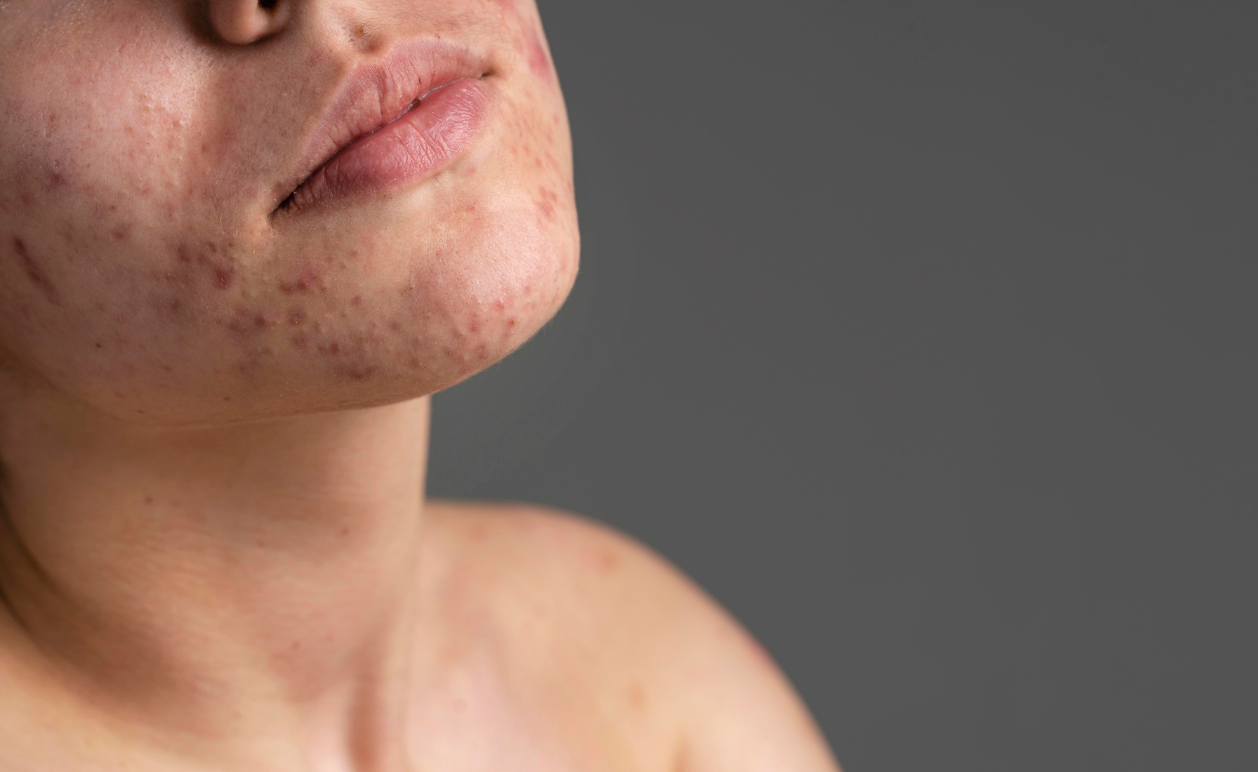 Ucpané póry - příčina